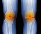 Radiografia colorata delle ginocchia artritiche — Foto stock