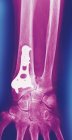 Перелом запястья, цветной фронтальный рентген . — стоковое фото