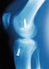 Farbiges Profil-Röntgenbild von Fixierungsgeräten (weiß) in den Knochen des Knies, das verwendet wird, um das vordere Kreuzband zu halten (nicht gesehen). — Stockfoto