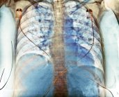 Radiographie pulmonaire colorée montrant une aspiration (zones sombres) dans les poumons d'une patiente de 76 ans présentant une hémorragie cérébrale étendue . — Photo de stock
