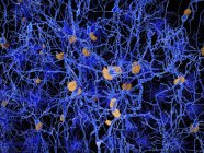 Plaques amyloïdes parmi les neurones — Photo de stock