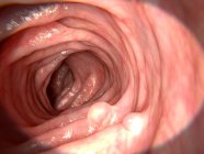 Polipi piccoli nell'intestino — Foto stock
