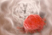 Oesophageal cancer rendering — Stock Photo