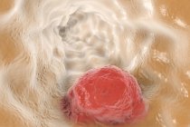 Oesophageal cancer rendering — Stock Photo