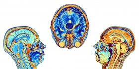 Images par résonance magnétique (IRM) fausses couleurs améliorées par ordinateur de deux coupes médio-sagittales et d'une coupe axiale (coupe transversale) à travers la tête d'une femme normale de 46 ans, montrant des structures du cerveau, de la colonne vertébrale et des tissus faciaux . — Photo de stock
