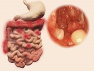 Pólipos intestinales, ilustración por ordenador . - foto de stock