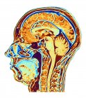 Computergestütztes Magnetresonanzbild (mri) eines mittleren sagittalen Schnitts durch den Kopf einer normalen 46-jährigen Frau, das Strukturen des Gehirns, der Wirbelsäule und des Gesichtsgewebes zeigt. — Stockfoto