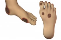 Illustrazione del computer che mostra la posizione comune delle ulcere nell'infezione diabetica del piede . — Foto stock
