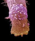 Cellule cancéreuse cutanée — Photo de stock