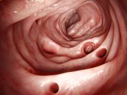 Diverticula in the large intestine, illustration. — Stock Photo