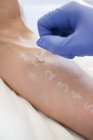 Пациент проходит тест на укол кожи в клинике аллергии . — стоковое фото