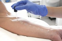 Patient soumis à un test de piqûre de peau dans une clinique d'allergie . — Photo de stock