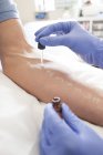 Patient soumis à un test de piqûre de peau dans une clinique d'allergie . — Photo de stock