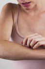 Close-up of woman scratching itchy arm. — Stock Photo