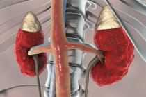 Digitale Illustration der groben Anatomie der Nieren mit chronischer Glomerulonephritis. — Stockfoto