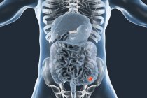 Cáncer de colon en el cuerpo humano, ilustración digital . - foto de stock