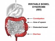 Digital artwork of digestive system suffering from irritable bowel syndrome. — Stock Photo