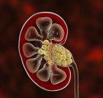 Digitale Illustration des Ausschnitts der menschlichen Niere, der Nierensteine enthält. — Stockfoto