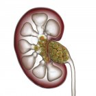 Ilustración digital de la sección del riñón humano que contiene cálculos renales . - foto de stock