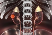 Digital illustration of kidneys cancer. — Stock Photo