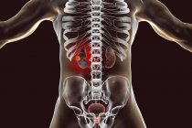 Illustrazione digitale del corpo umano con cancro ai reni . — Foto stock