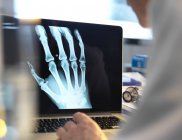 Docteur visualisation X-ray de la main sur l'écran de l'ordinateur portable . — Photo de stock