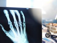 Primer plano de rayos X de la mano en la pantalla del ordenador portátil . - foto de stock