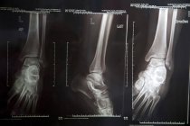 Primer plano de los rayos X de las piernas inferiores . - foto de stock