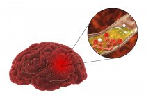 Ilustración de bloqueo arterial que causa accidente cerebrovascular debido a la aterosclerosis . - foto de stock