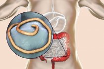 Ilustración digital de la lombriz en el intestino humano . - foto de stock