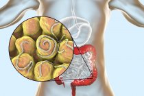 Ilustración digital de múltiples gusanos en el intestino humano . - foto de stock