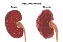 Comparison of gross anatomy of acute and chronic pyelonephritis, illustration. — Stock Photo