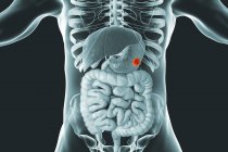 Cancro allo stomaco nel corpo umano, illustrazione digitale . — Foto stock