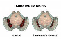 Illustrazione di substantia nigra sana e degenerata del cervello umano
. — Foto stock