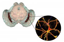 Ilustración de sustancia negra degenerada y neuronas dopaminérgicas en la enfermedad de Parkinsons
. - foto de stock