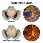 Ilustración de sustancia negra sana y degenerada del cerebro humano con neuronas dopaminérgicas
. - foto de stock