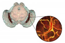 Ilustração de substância negra degenerada e neurônios dopaminérgicos na doença de Parkinsons
. — Fotografia de Stock