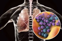 Polmoni umani con polmonite e primo piano di batteri e virus . — Foto stock
