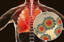 Silhouette polmonare causata da virus del morbillo, illustrazione concettuale
. — Foto stock