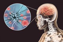 Концептуальная иллюстрация человеческого мозга с признаками вирусного энцефалита и крупным планом вирусных частиц . — стоковое фото