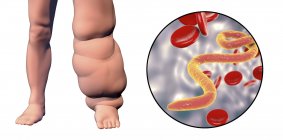 Ilustración digital de la pierna humana afectada por filariasis linfática y primer plano del parásito gusano microfilaria . - foto de stock