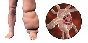Ilustración digital de la pierna humana afectada por filariasis linfática y primer plano de gusanos nematodos parásitos
. - foto de stock