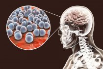 Infezione cerebrale causata da batteri Streptococcus pneumoniae, illustrazione digitale . — Foto stock