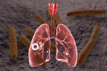Cavidade da tuberculose pulmonar fibrocavernosa em pulmão direito com camada fibrosa bem formada
. — Fotografia de Stock