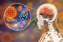 Conceptual illustration of human brain with signs of viral encephalitis and close-up of virus particles. — Stock Photo