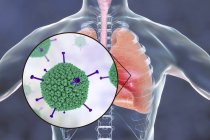 Gros plan sur l'adénovirus infectant les poumons humains, illustration numérique . — Photo de stock
