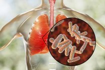Menschliche Lungen mit bakterieller Lungenentzündung und Nahaufnahme von Bakterien. — Stockfoto