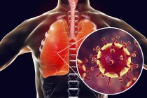 Infección pulmonar por el virus MERS, ilustración conceptual
. - foto de stock