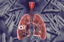 Cavidade da tuberculose pulmonar fibrocavernosa em pulmão direito com camada fibrosa bem formada
. — Fotografia de Stock