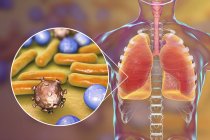 Menschliche Lungen mit Lungenentzündung und Nahaufnahme von Bakterien und Viren. — Stockfoto